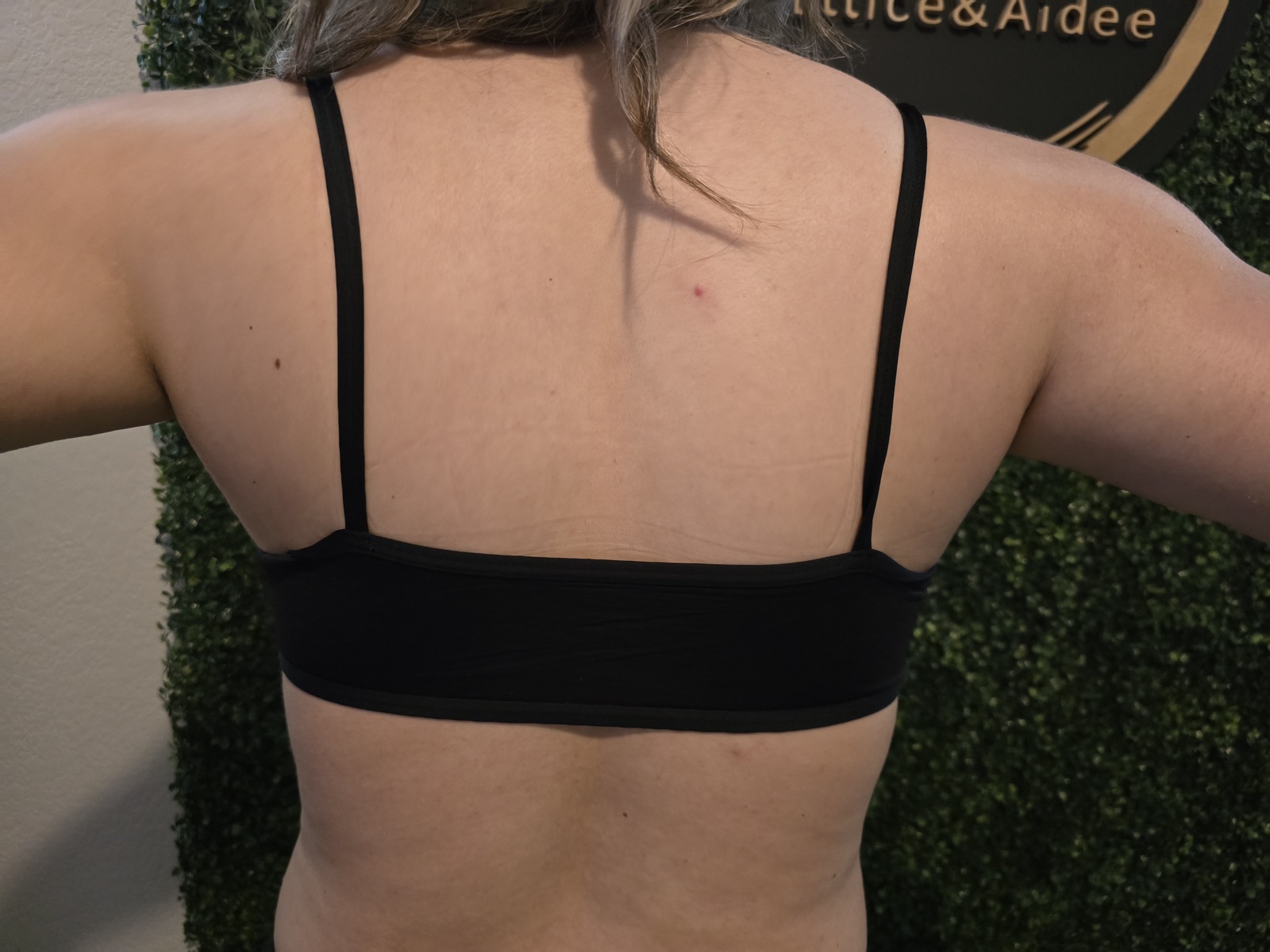 Back & Bra Line after treatment