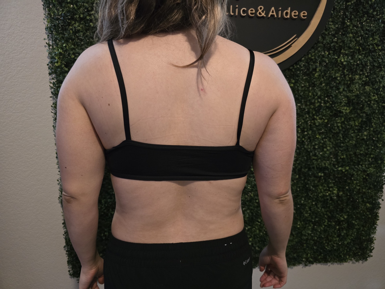 Back & Bra Line before treatment