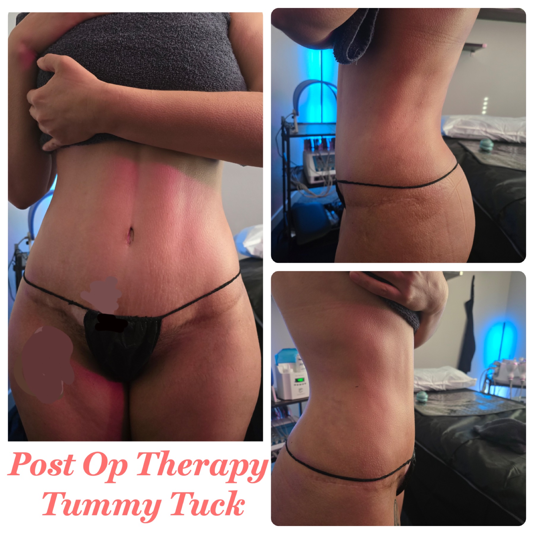 Post-Op Therapy · Tummy Tuck